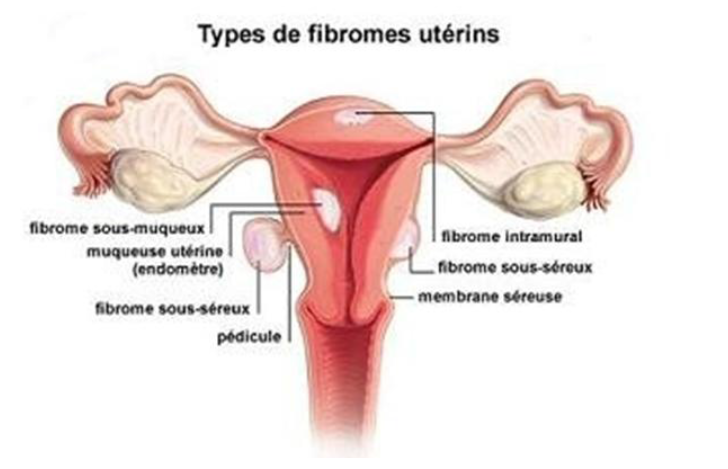 Myomectomie | Hôpital DCSS